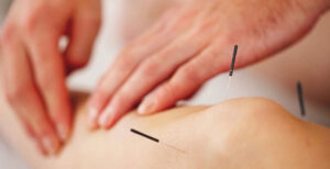 Pijnlijke schouders opgelost door acupunctuur